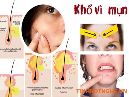 Bị mụn lâu ngày không khỏi do nóng trong hoặc nhiễm độc